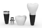 Impianti dentali Impianti dentali