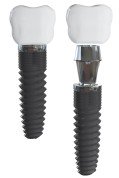 Impianti dentali Impianti dentali